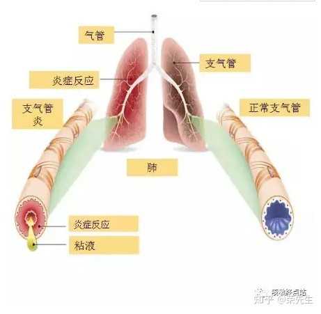 得了支气管炎，吃药已经一个星期，每天晚上咳嗽的都睡不成觉，有什么有效的方法能克服晚上的咳嗽吗？