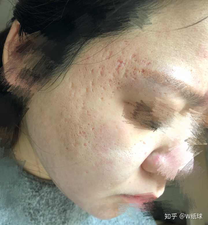 祛痘坑plasma 空军总医院美容激光中心