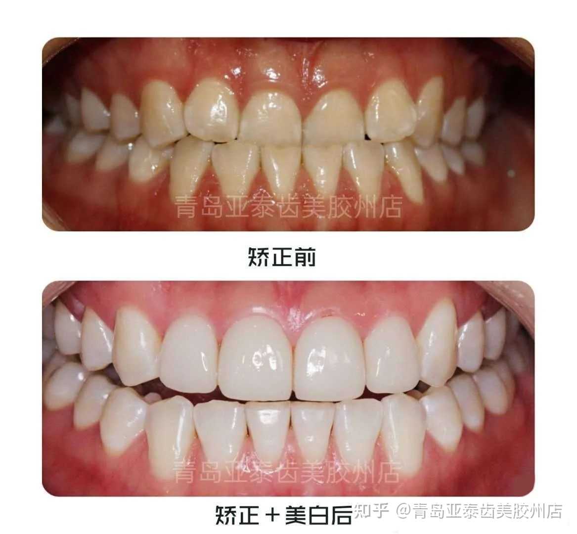 青岛亚泰齿美胶州店 的想法: 有朋友私信,我想让牙齿变白,请问该怎么