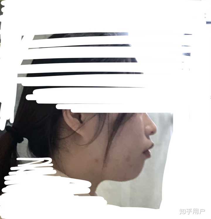 大学终于决定要去整牙了,现在才整了不到一年,因为我是骨型和牙型都有