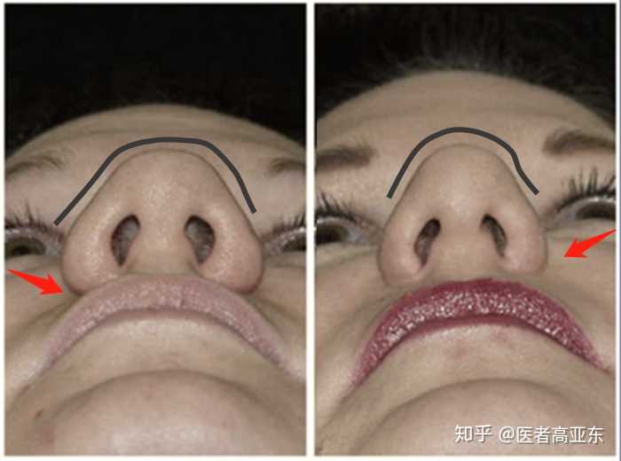 祛除了部分鼻翼的脂肪,缩小鼻翼;因为鼻小柱发达,有一定的支撑作用了