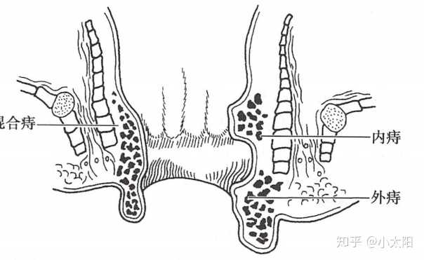 另有血栓性外痔,结缔组织性外痔和炎性外痔;3,混合痔:位于齿状线附近