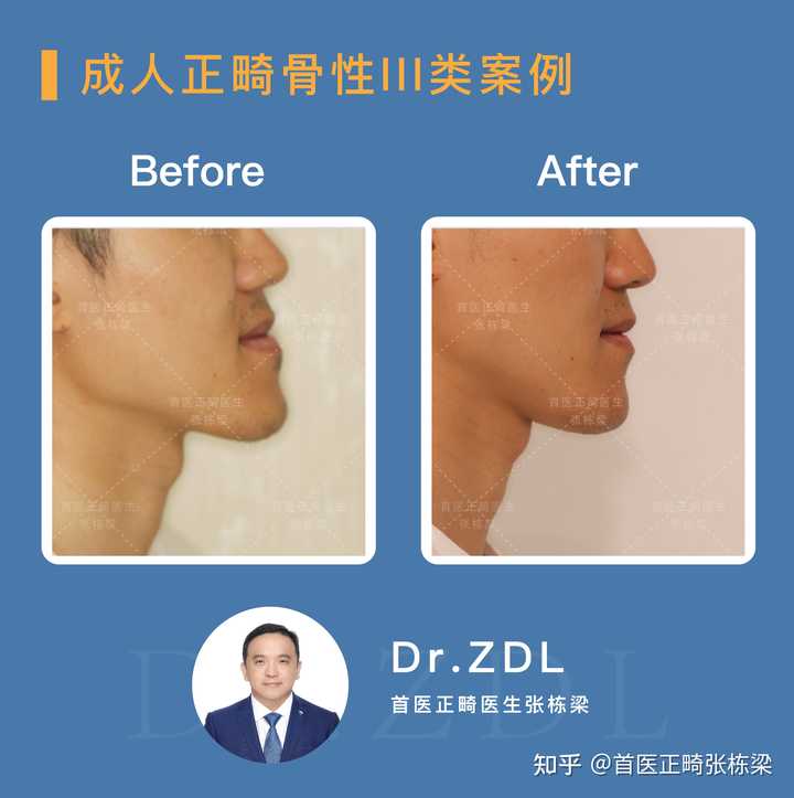做正颌手术是怎样的体验? - 知乎