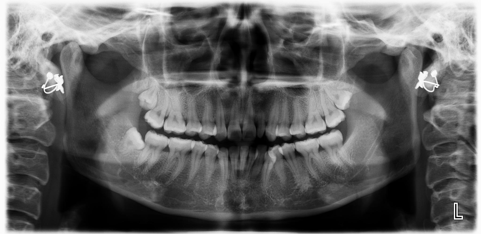 去两家牙科医院咨询箍牙:一家医生说要上下箍