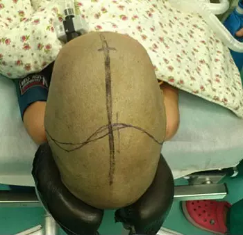 craniosynostosis,ssc)指由於顱頂縫(額縫,冠狀縫,矢狀縫和人字縫)