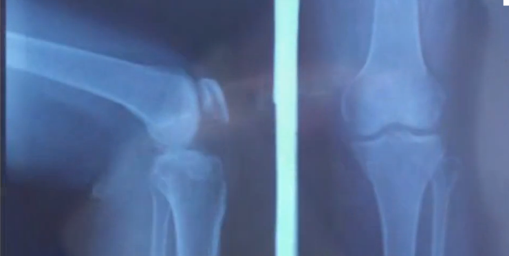 求治膝盖积水的办法? - 明威说的回答 - 知乎