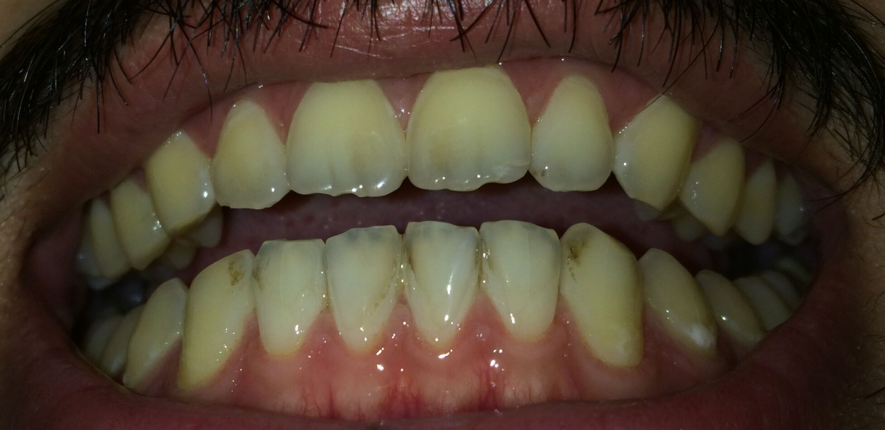 有牙医吗,牙齿上出现褐色痕迹怎么回事?