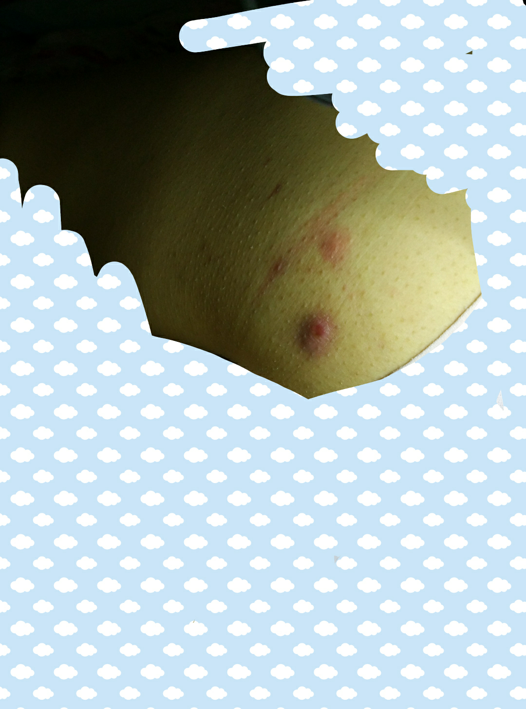 屁股上长了红痘痘是怎么回事?