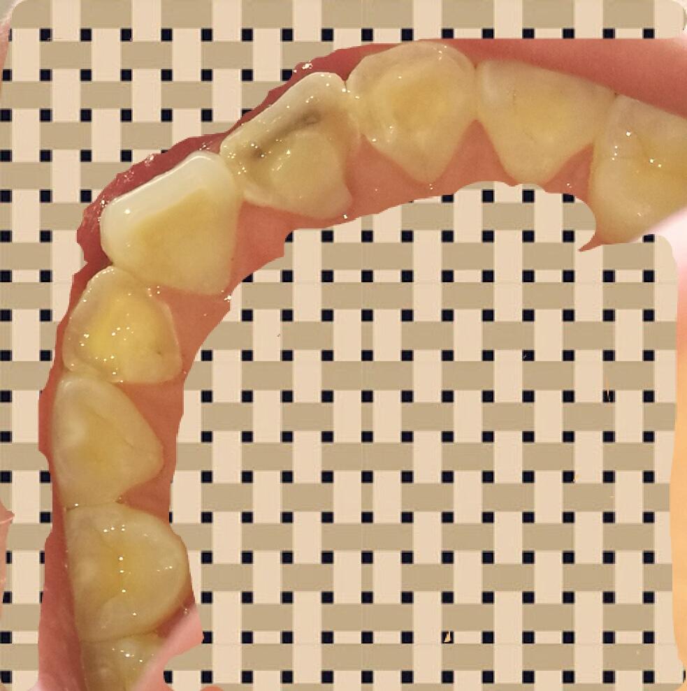 牙齿髓石图片