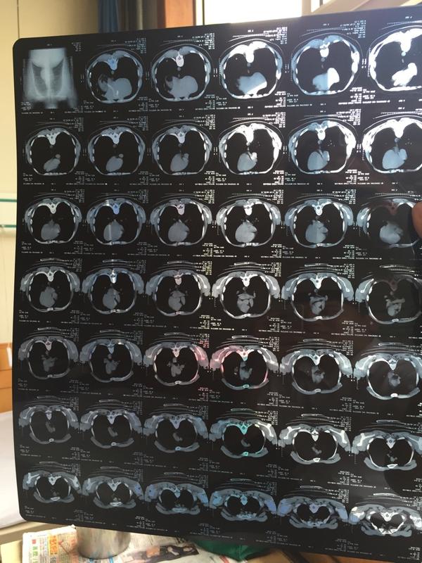 肺炎左肺下高密度影大神看看有问题吗