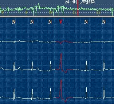 早搏即为心搏 提早到来,配两个holter的图演示一下.