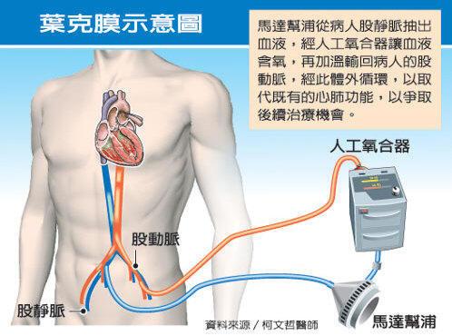 叶克膜ecmo 体外膜肺氧合 在大陆为何得不到普及 知乎