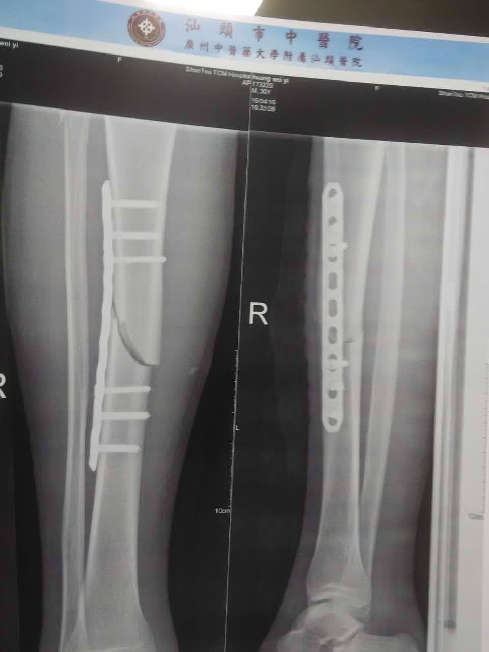 车祸 胫腓骨折 请问有什么后遗症吗 该小问短知乎