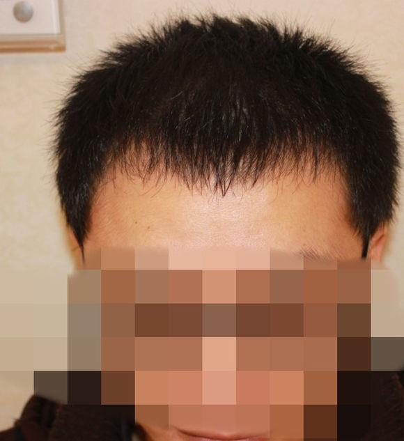 发际线太高怎么办? - 一条死龙的回答