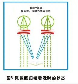 再者当青少年阅读时,配戴一副具有附加基底向内三棱镜的低度凸透镜