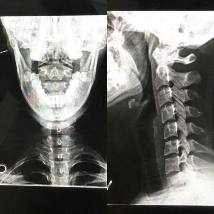 下面上兩張典型的寰樞關節半脫位的影像學檢查