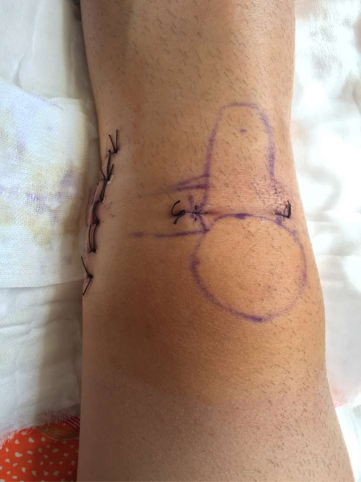 最后,伤病真的是运动员的噩梦,祝大家身体健康少一些伤病吧.