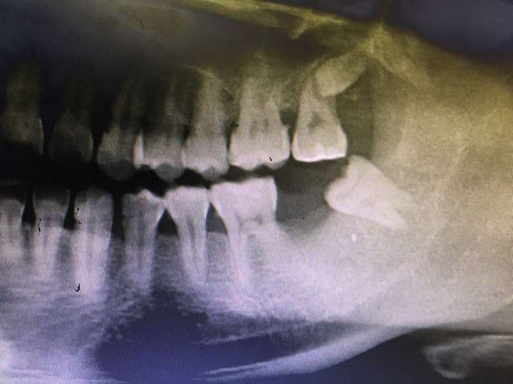 牙槽骨骨刺图片
