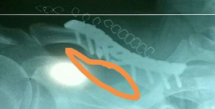 琵琶骨确认是肩胛骨了,先说下上面几个认为是锁骨的锁法.