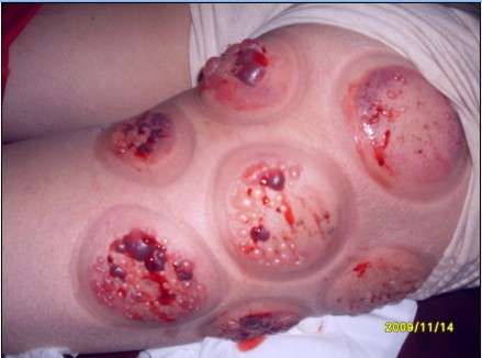 菲尔普斯身上的圈圈是拔火罐吗拔火罐到底是有益有害呢