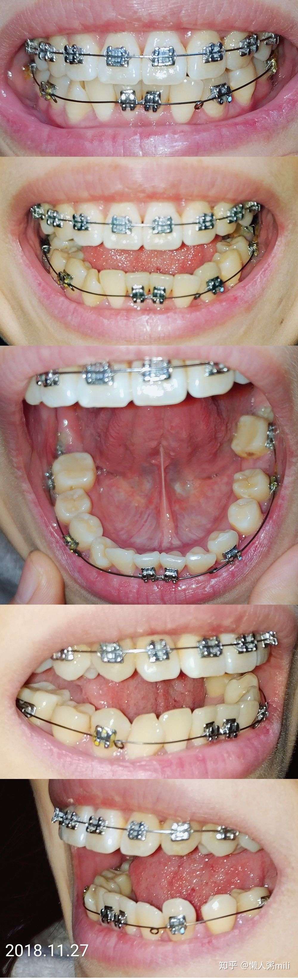 24岁拔磨牙大牙智齿前移替代7号牙牙齿矫正记录 知乎