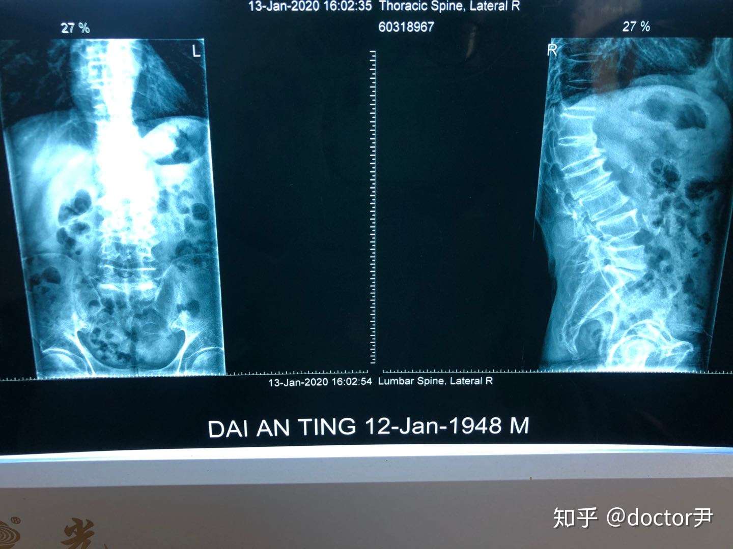 老年性腰椎间盘突出症 腰椎1 2度滑脱 安全有效的复健训练 知乎