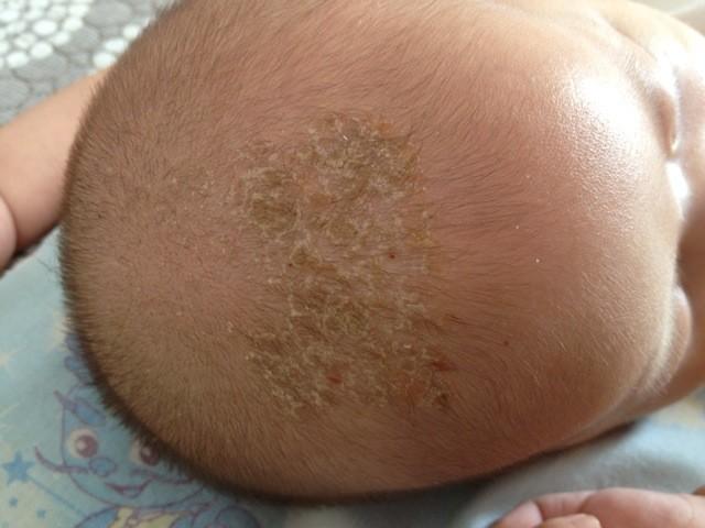轻度婴儿脂溢性湿疹图图片