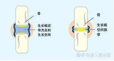 在骨骺软骨未完全骨化前