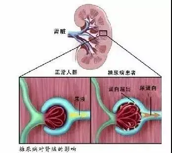 内分泌专家陆卫平教授解析糖尿病肾病