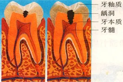 牙釉质龋的病理分层图图片