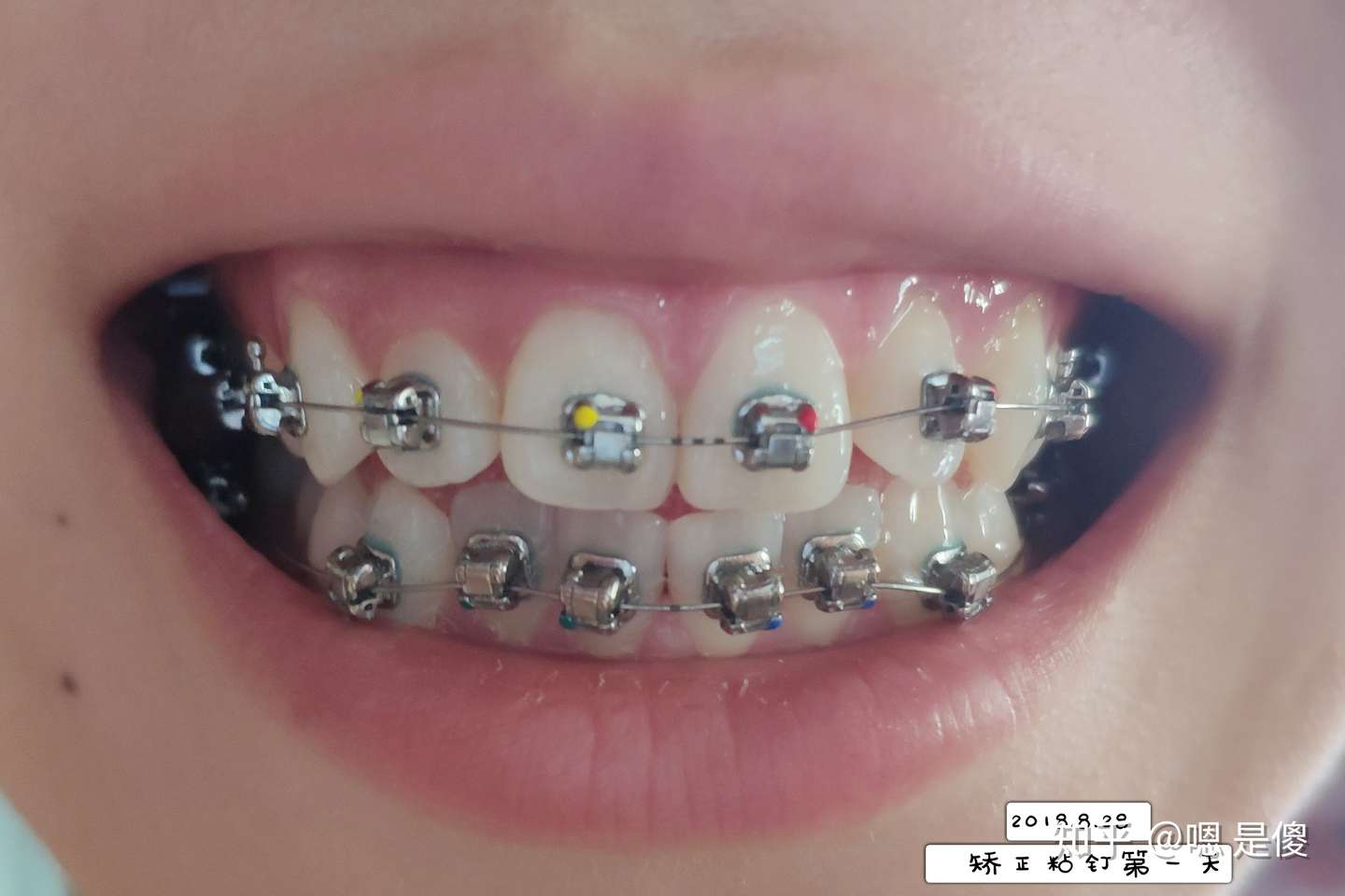 矫正牙齿记录 拔牙四颗 打骨钉 知乎