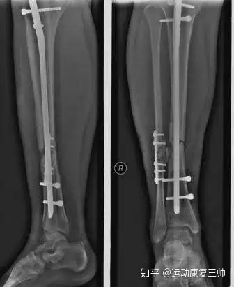 胫骨骨折的术后康复方案 知乎