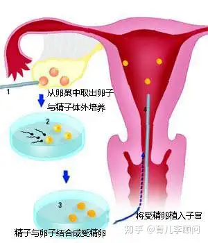 胚胎移植后在子宫图片图片