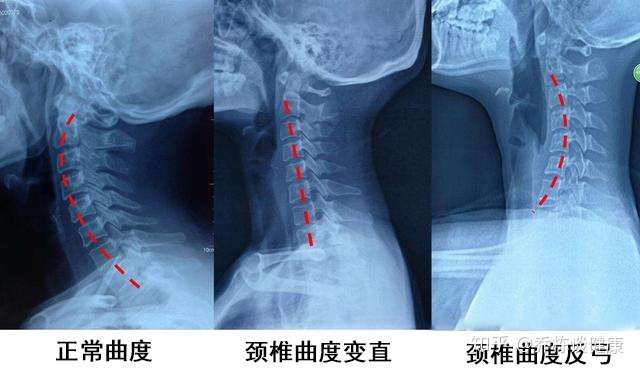 患有颈椎病 颈椎间盘突出 别焦虑 学会根据症状去处理 不难恢复 知乎