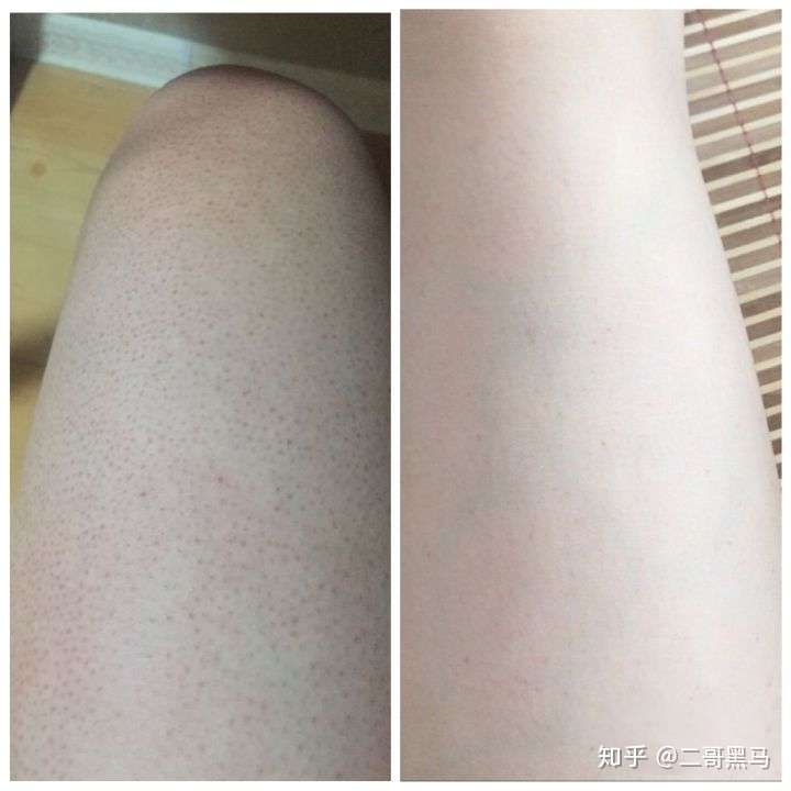 鸡皮肤还叫啥(鸡皮肤还叫啥名字) 鸡皮肤还叫啥(鸡皮肤还叫啥名字)