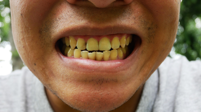 牙齿很黄怎么才可以变白