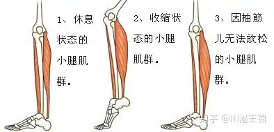 收藏|血液透析过程中肌肉痉挛的那些事!