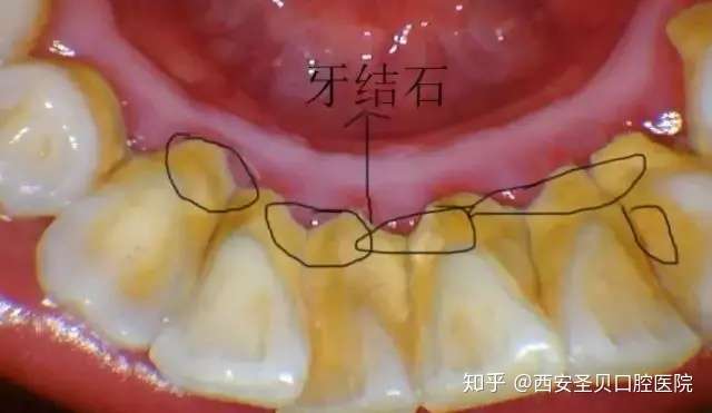 医生 洗牙后我牙齿酸软咋回事 知乎