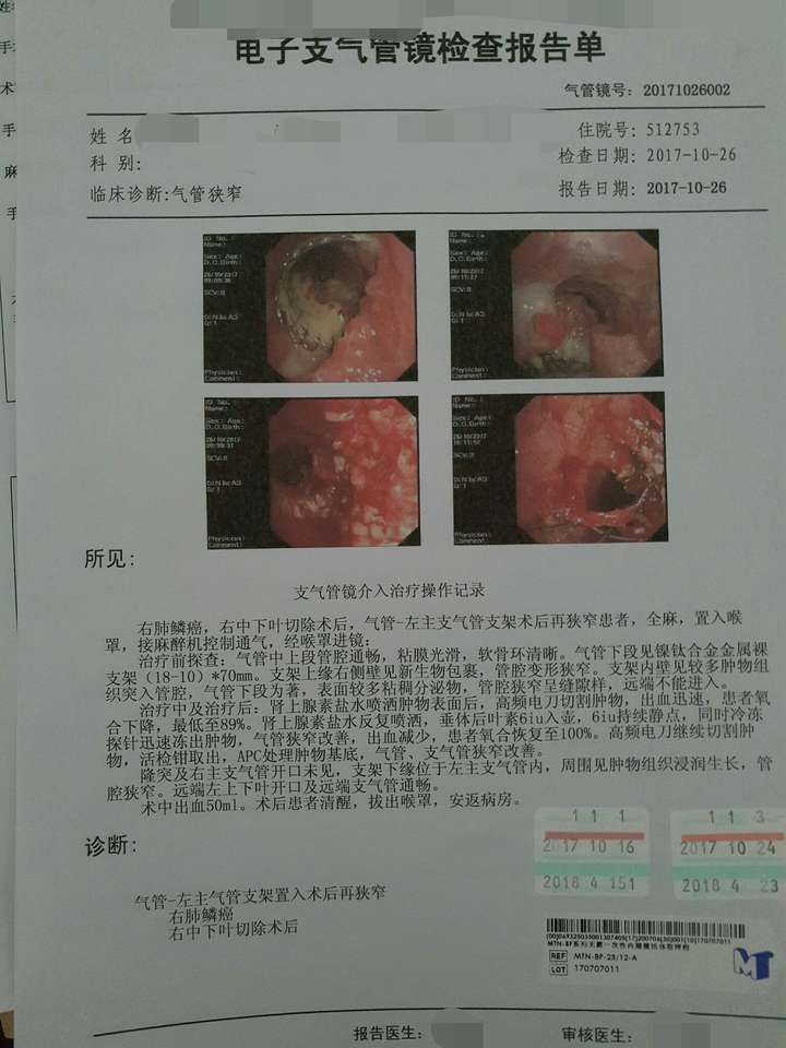 做支气管镜检查是一种什么体验?