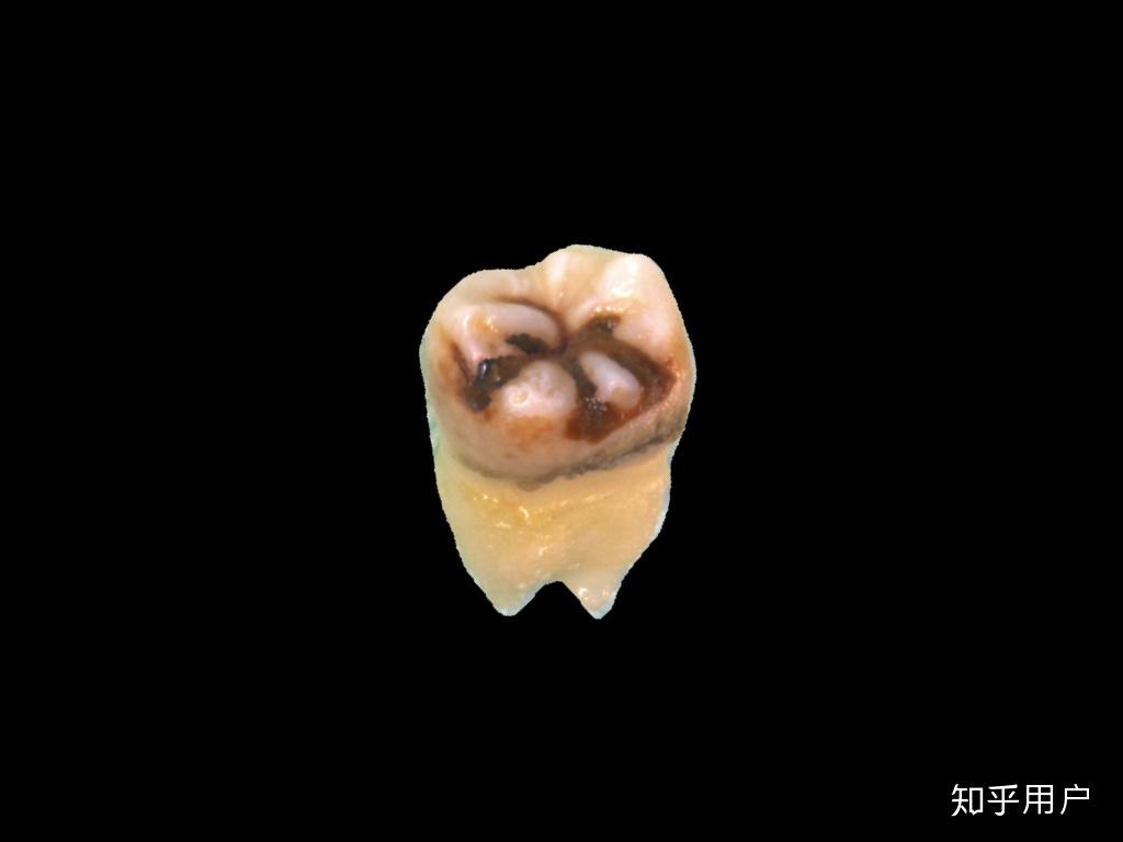 这是一个从病人身上拔下来的牙齿,它就是一个附着着大量牙结石的牙齿