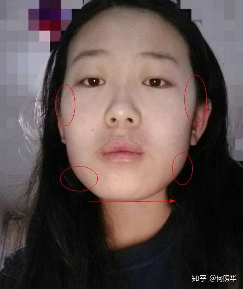 下颌骨外扩 并且感觉脸型不对称 不想做什么削骨手术 有什么方法?