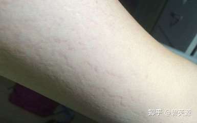 膨胀纹也是生长纹,生长纹是因为骨骼的增长速度超过了肌肤的弹力抵侣