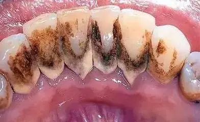 Photos of the inside of the mouth of a typical patient with no teeth cleaning habits