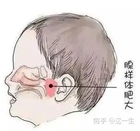 孩子有腺樣體肥大過敏性鼻炎治那個先