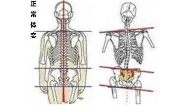 骨盆问题不仅影响脊柱侧弯 也是女性血液循环不畅的重要原因 知乎