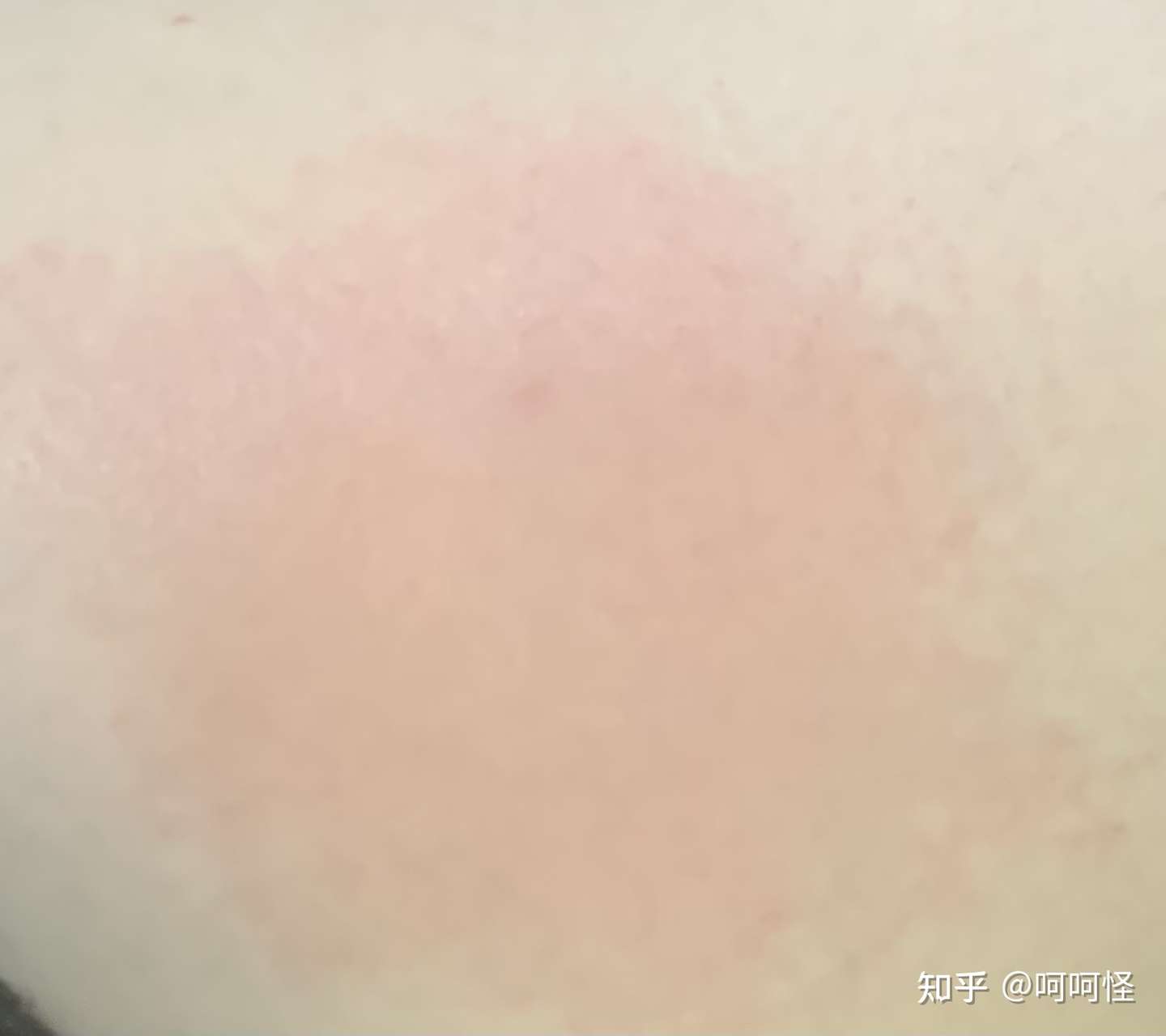 人生在世 磕磕碰碰难免 这次是深二度 三度烧伤的护理 知乎