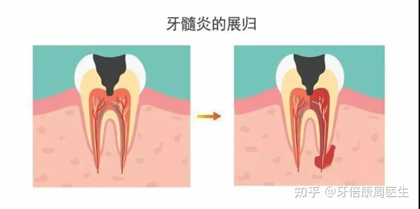 牙 髓 炎 自 愈