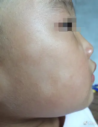其实宝宝脸上长白斑,最有可能的一种情况是得了白色糠疹,有些地方也称