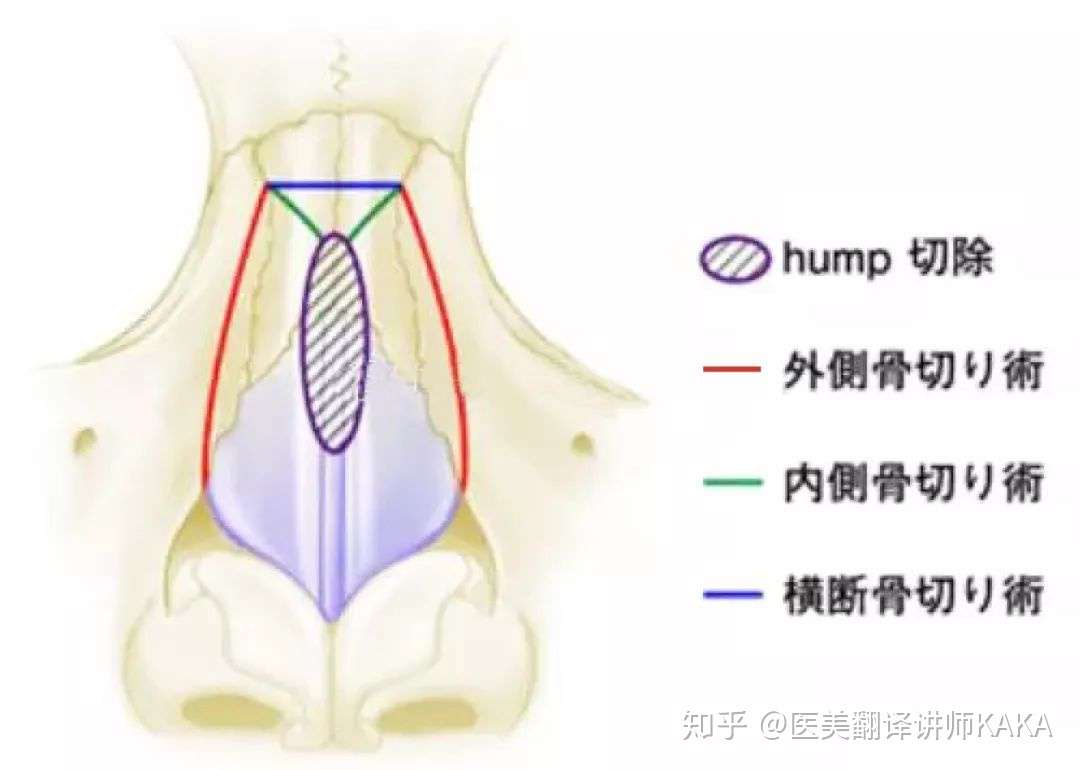 日本鼻部整形扫盲大全 知乎