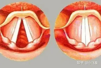 甲状腺术后喉返神经受损声带麻痹声音嘶哑怎么办